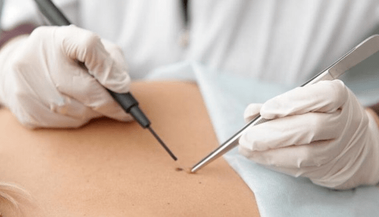 A papilloma eltávolításának jellemzői