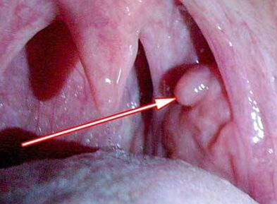 Papilloma a gégében