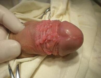 Papilloma egy tagra