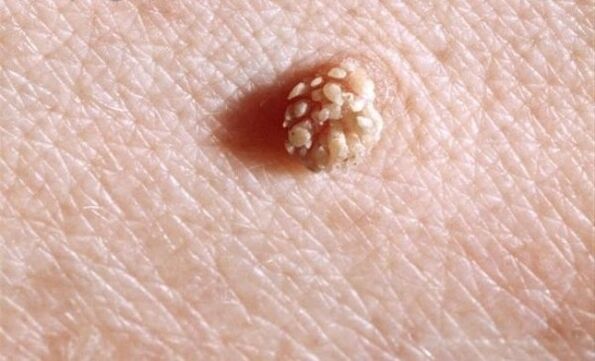 Papilloma az emberi testen